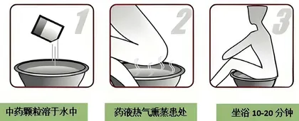 中药坐浴帮助缓解青少年肛肠不适1