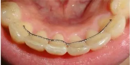 牙齿矫正后勿忘佩戴保持器1