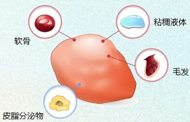了解畸胎瘤