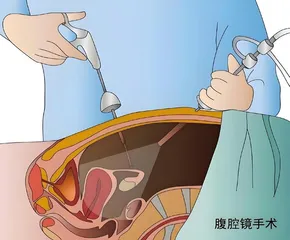 了解卵巢巧克力囊肿1