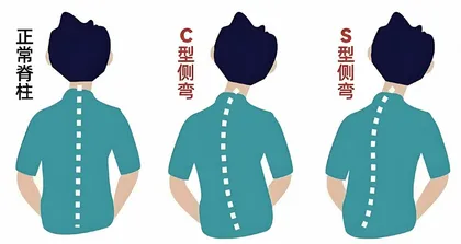 青少年脊柱侧弯的早期发现与预防