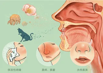 儿童过敏性鼻炎应如何用药？