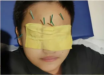 针灸治疗青少年近视