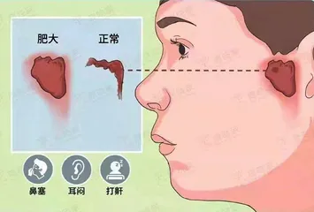 青春期腺样体切除术后如何护理？