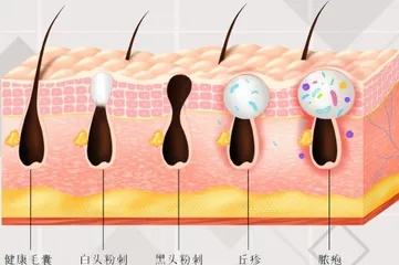 青春期痤疮的形成原因与应对策略1