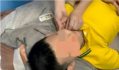 了解儿童面瘫