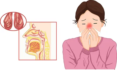 鼻炎与感冒须分清
