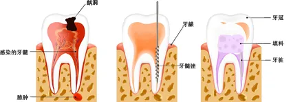 远离牙髓炎，早防是关键