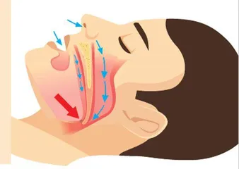 睡眠呼吸暂停综合征