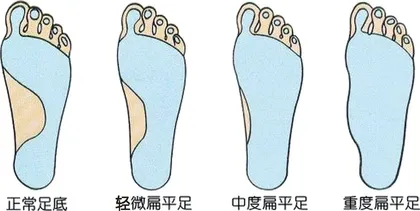 扁平足要早发现早治疗