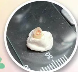 小小的乳牙，大大的洞