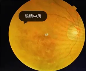 原来眼睛也会“中⻛”1