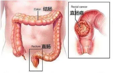 研究人员揭示阿司匹林抑制肠癌的原理1