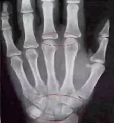 育儿圈热议的骨龄和年龄到底有什么关系1