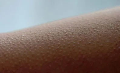 鸡皮疙瘩与鸡皮肤到底是什么?3