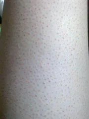 鸡皮疙瘩与鸡皮肤到底是什么?4
