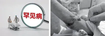 这种罕见病,“是身上永远无法停歇的一种痛”3