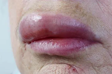 过敏之源6