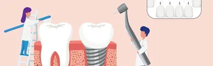 全口种了牙,这些要注意0