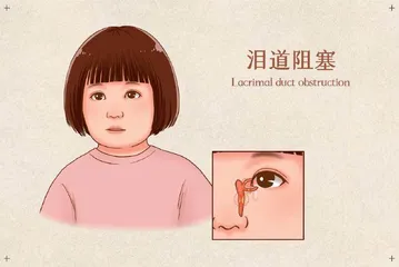 泪道堵了，当真让人欲哭无泪