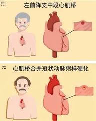 貌似冠心病实则心肌桥