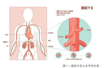 腹部剧痛？当心腹腔干夹层这颗“雷”