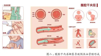 腹部剧痛?当心腹腔干夹层这颗“雷”1