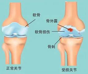 关节痛是 一种什么痛1