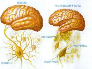 阿尔茨海默病:谁是元凶?3