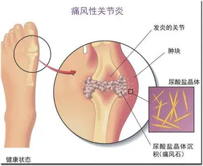 身体里的“坏矿”4
