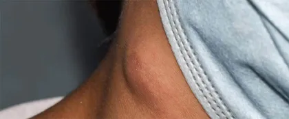 淋巴结　人体的“烽火台”