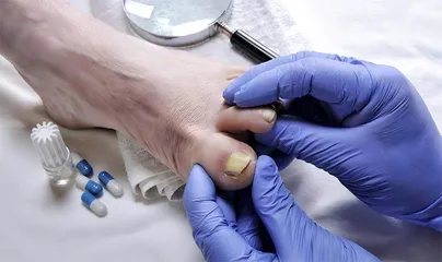 指甲灰就是灰指甲吗2
