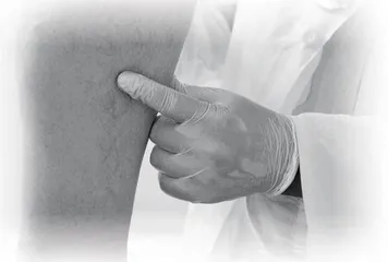 静脉曲张：如何缓解腿部不适与疲劳