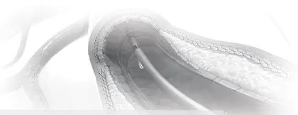 血管介入治疗的优缺点