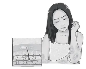 银屑病护理小贴士