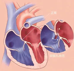 头疼频发可能是先心病惹的祸