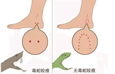 被蛇咬伤怎么办,急救知识来帮忙1