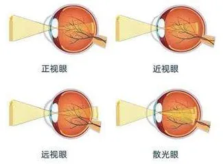 儿童视力筛查发现屈光不正，怎么办 