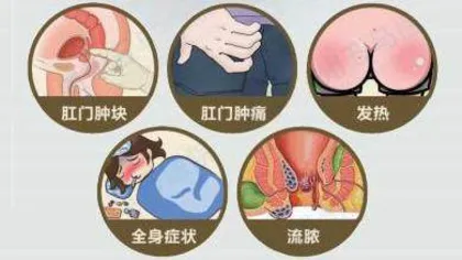 儿童肛周脓肿的护理 