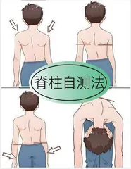 守护脊柱健康：脊柱侧弯的防治之道 