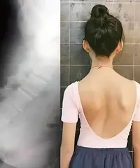  不可忽视的青少年特发性脊柱侧弯