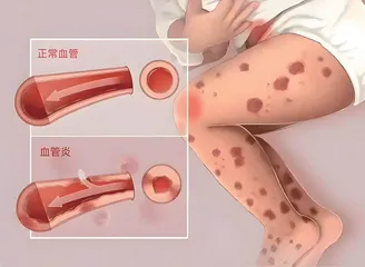 青少年皮肤紫癜如何应对