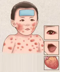 儿童川崎病的治疗和护理