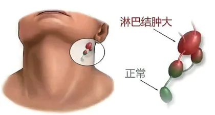 颈部淋巴结结核的识别与应对