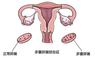 警惕青春期多囊卵巢综合征