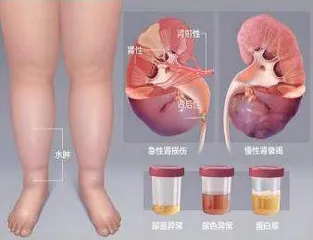 青少年肾病综合征的用药与综合管理策略