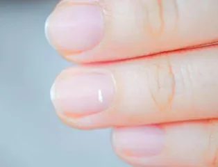 孩子只要没发热就不是肺炎？4
