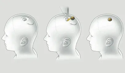 芯片入脑,进化时刻已至?1