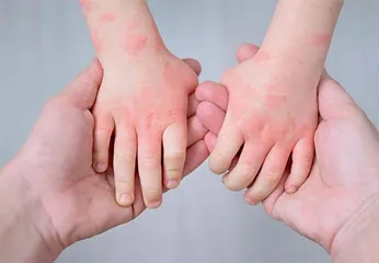 法国:湿疹患者在医院工作坊自我疗愈1