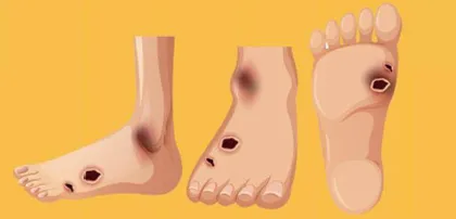 消除糖尿病患者难以承受之痛3